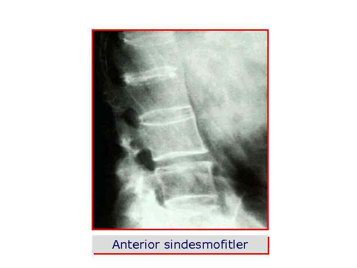 Anterior sindesmofitler 