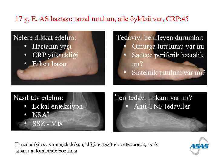 17 y, E. AS hastası: tarsal tutulum, aile öyküsü var, CRP: 45 Nelere dikkat