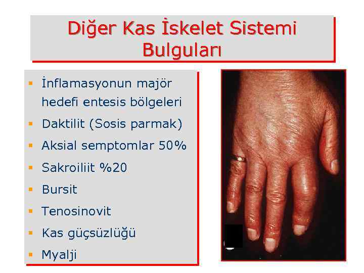 Diğer Kas İskelet Sistemi Bulguları § İnflamasyonun majör hedefi entesis bölgeleri § Daktilit (Sosis