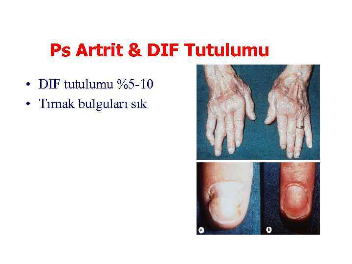 Ps Artrit & DIF Tutulumu • DIF tutulumu %5 -10 • Tırnak bulguları sık