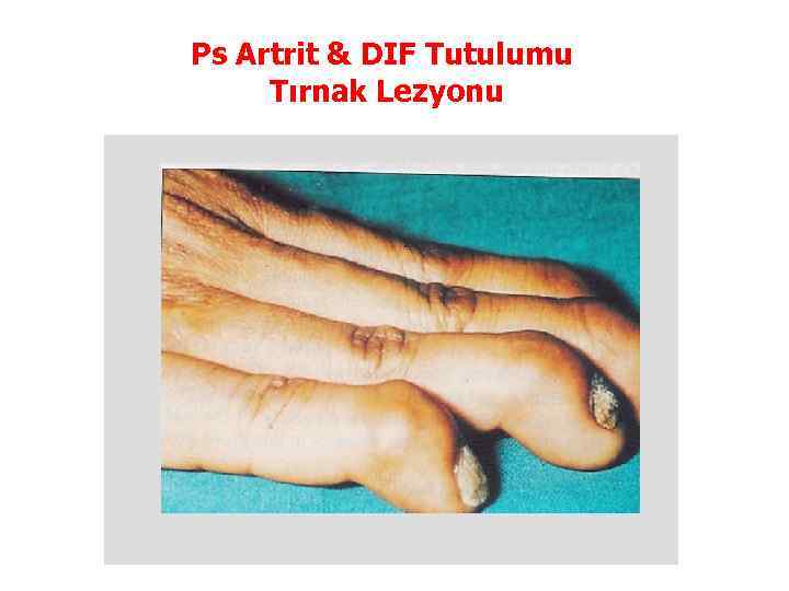 Ps Artrit & DIF Tutulumu Tırnak Lezyonu 