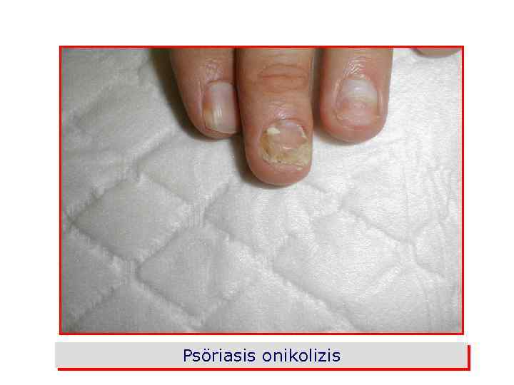 Psöriasis onikolizis 