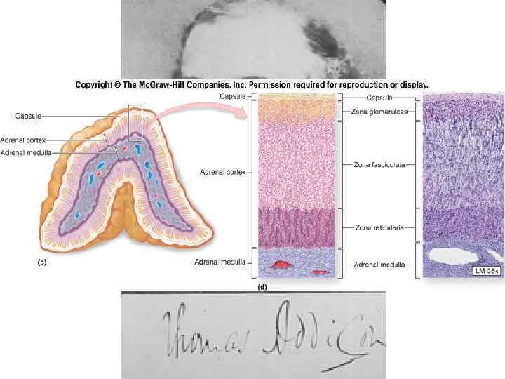 Adrenal Yetmezlik Uzm. Dr. E. Murat AKBAŞ Thomas Addison (1793 -1860) 