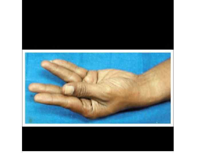 Semptom ve Bulgular • • • Parestezi, Kramp, Kas güçsüzlüğü, Myalji, Disfaji, İritabilite, Depresyon