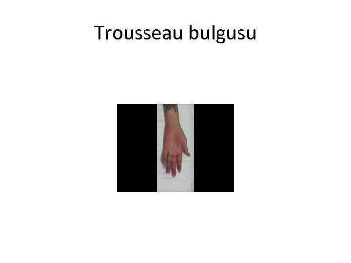 Trousseau bulgusu 