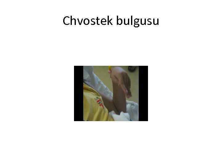 Chvostek bulgusu 