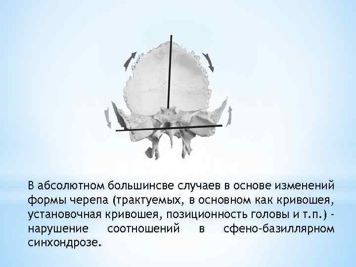 В абсолютном большинсве случаев в основе изменений формы черепа (трактуемых, в основном как кривошея,
