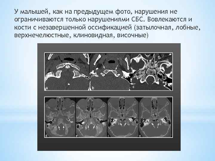 У малышей, как на предыдущем фото, нарушения не ограничиваются только нарушениями СБС. Вовлекаются и