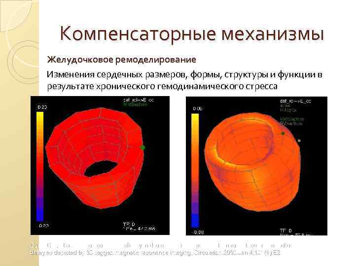 Компенсаторные механизмы Желудочковое ремоделирование Изменения сердечных размеров, формы, структуры и функции в результате хронического