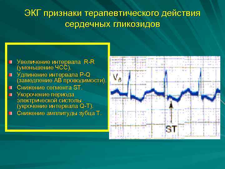 ЭКГ признаки терапевтического действия сердечных гликозидов Увеличение интервала R-R (уменьшение ЧСС). Удлинение интервала P-Q