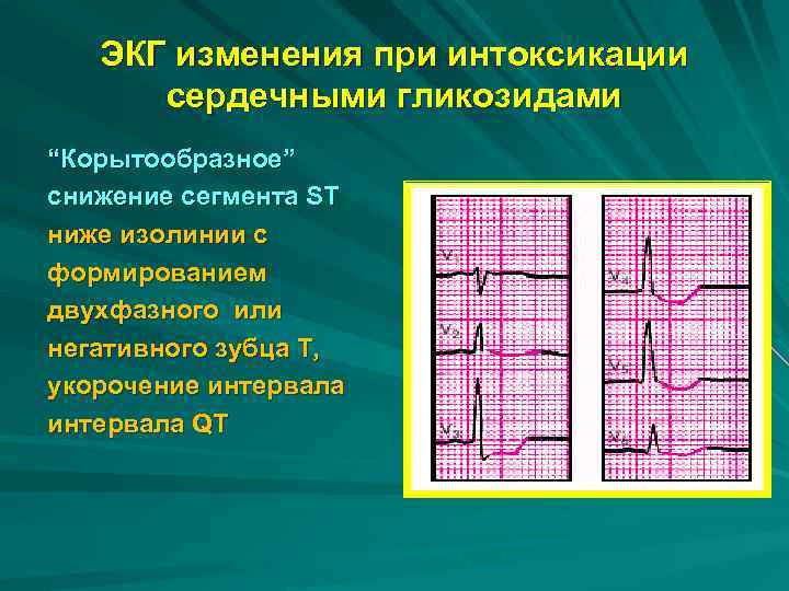 ЭКГ изменения при интоксикации сердечными гликозидами “Корытообразное” снижение сегмента SТ ниже изолинии с формированием