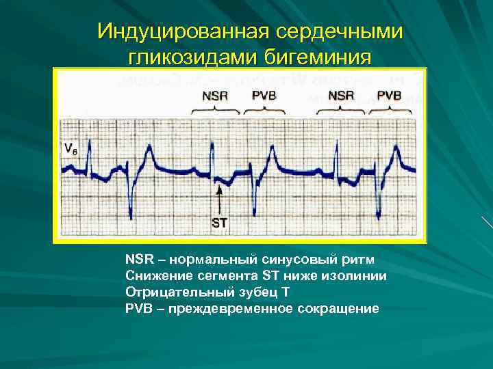 Индуцированная сердечными гликозидами бигеминия NSR – нормальный синусовый ритм Снижение сегмента ST ниже изолинии