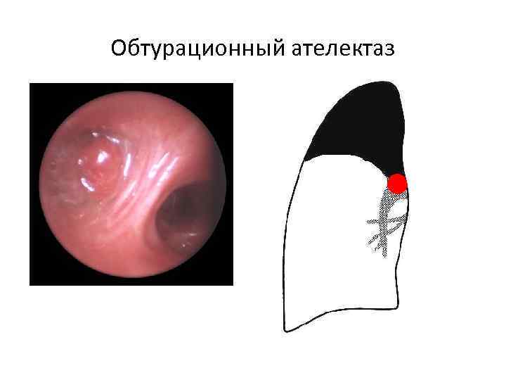 Обтурационный ателектаз 