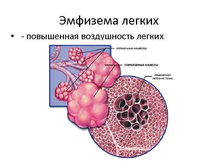 Эмфизема легких • - повышенная воздушность легких 