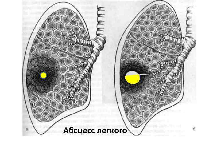 Абсцесс легкого 