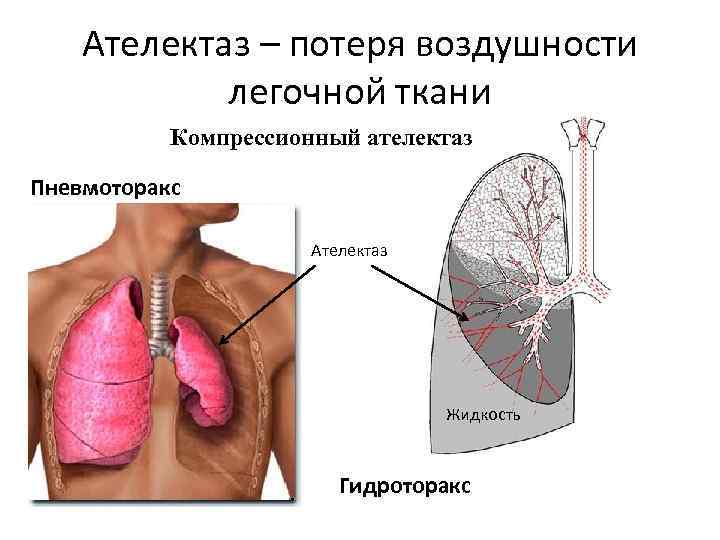 Ателектаз – потеря воздушности легочной ткани Компрессионный ателектаз Пневмоторакс Ателектаз Жидкость Гидроторакс 