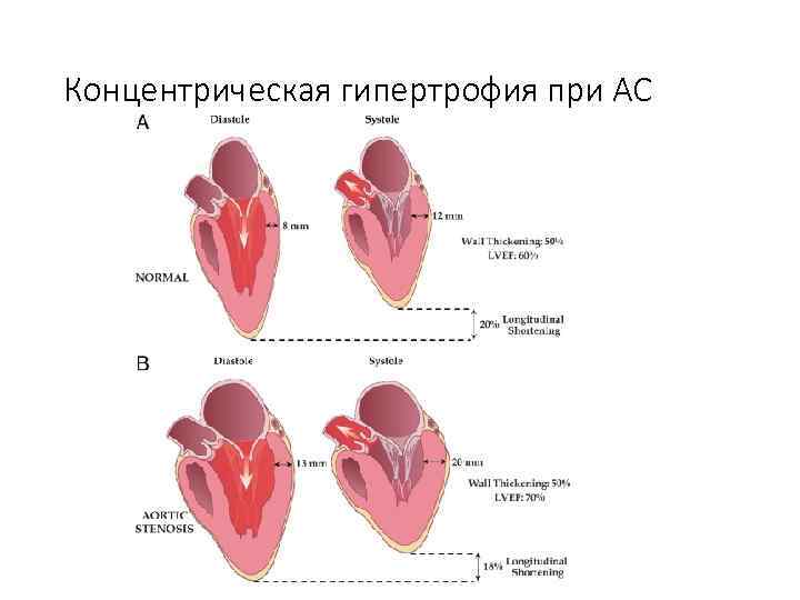 Концентрическая гипертрофия при АС 