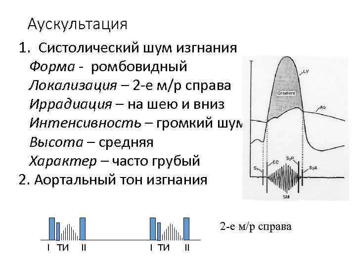 Аускультация 1. Систолический шум изгнания Форма - ромбовидный Локализация – 2 -е м/р справа