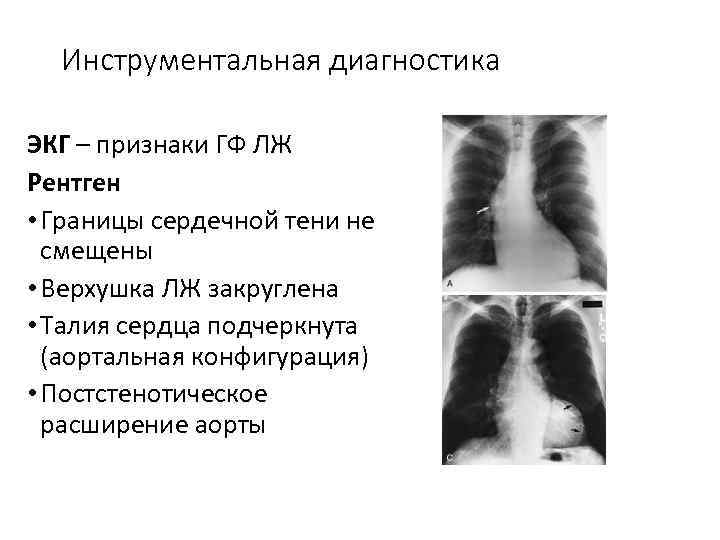 Инструментальная диагностика ЭКГ – признаки ГФ ЛЖ Рентген • Границы сердечной тени не смещены