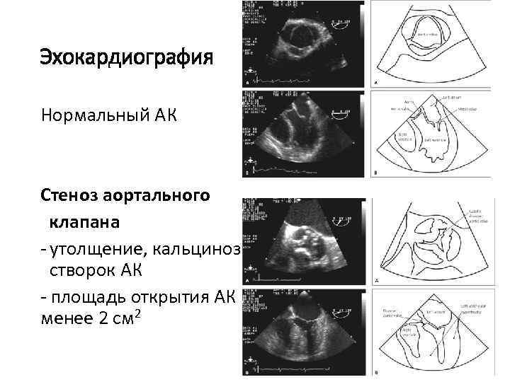 Эхокардиография Нормальный АК Стеноз аортального клапана - утолщение, кальциноз створок АК - площадь открытия