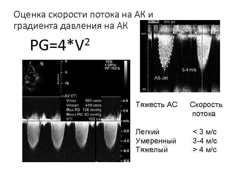 Оценка скорости потока на АК и градиента давления на АК 2 PG=4*V Тяжесть АС