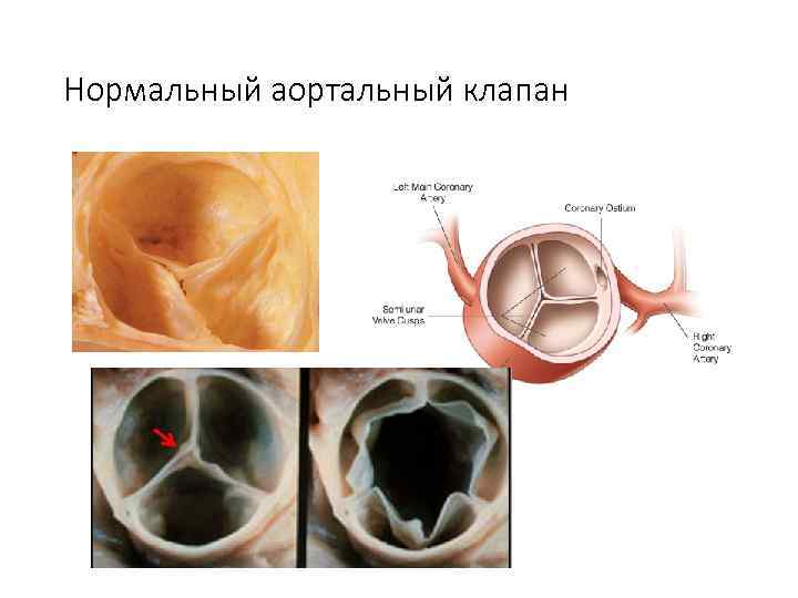 Нормальный аортальный клапан 
