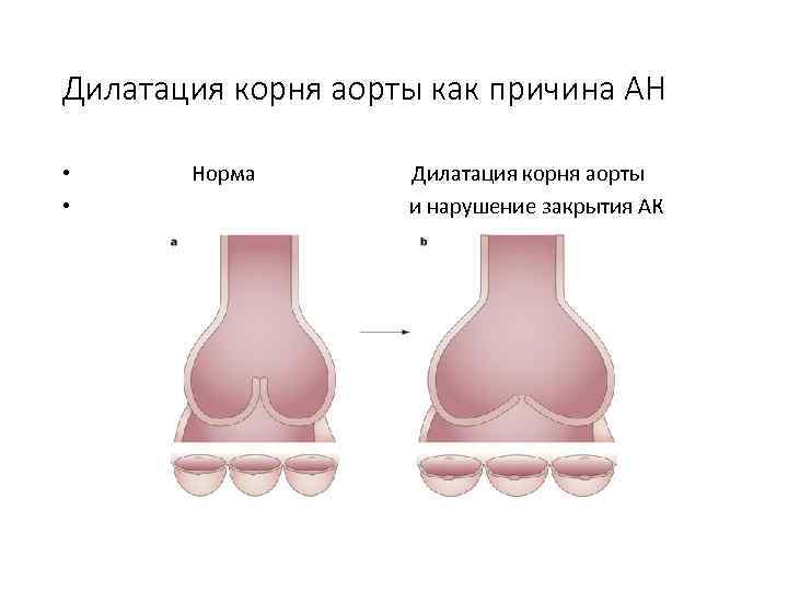 Дилатация корня аорты как причина АН • • Норма Дилатация корня аорты и нарушение