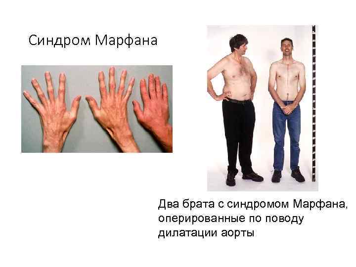 Синдром Марфана Два брата с синдромом Марфана, оперированные по поводу дилатации аорты 