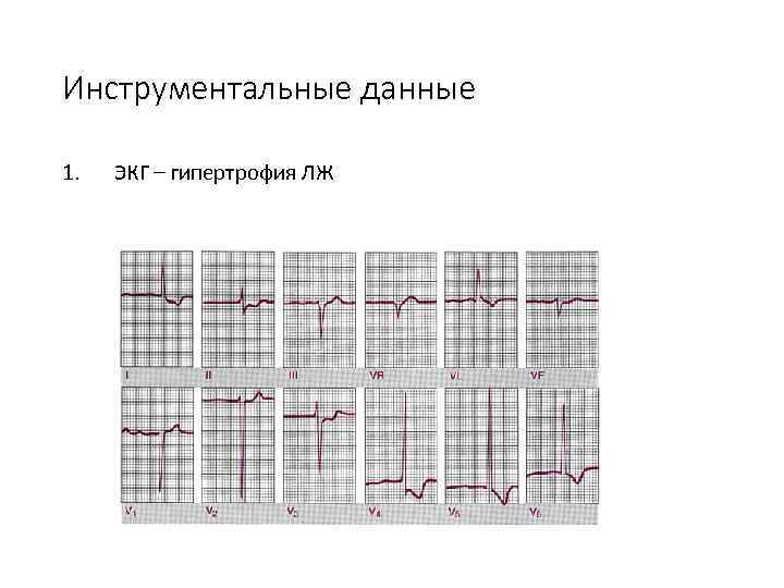 Инструментальные данные 1. ЭКГ – гипертрофия ЛЖ 
