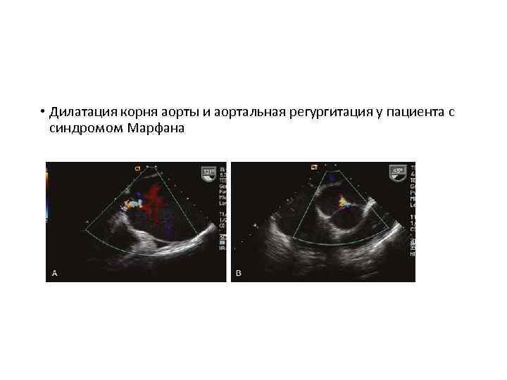  • Дилатация корня аорты и аортальная регургитация у пациента с синдромом Марфана 