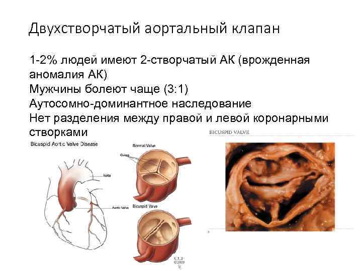Двухстворчатый аортальный клапан 1 -2% людей имеют 2 -створчатый АК (врожденная аномалия АК) Мужчины