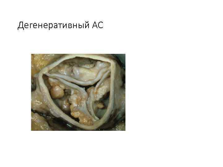Дегенеративный АС 