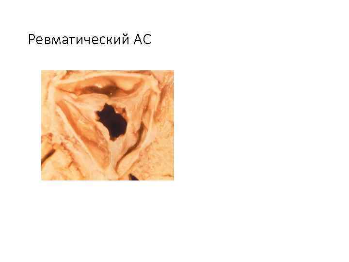 Ревматический АС 