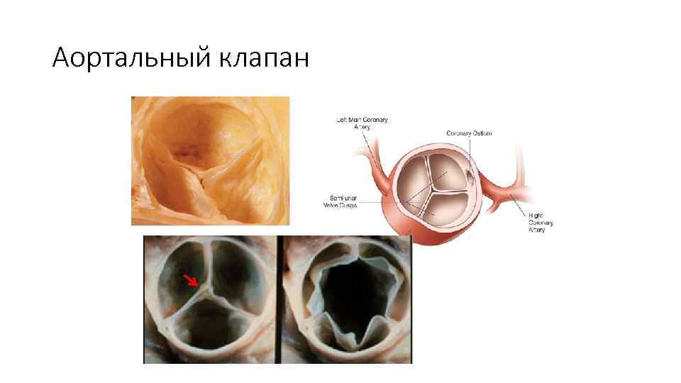 Аортальный клапан 