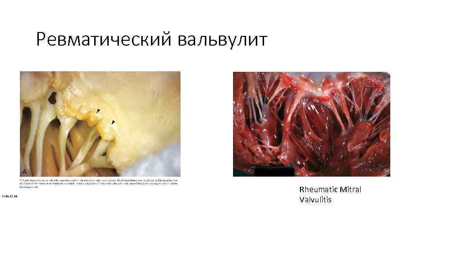 Ревматический вальвулит Rheumatic Mitral Valvulitis 