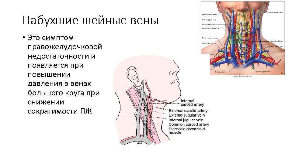 Набухшие шейные вены • Это симптом правожелудочковой недостаточности и появляется при повышении давления в