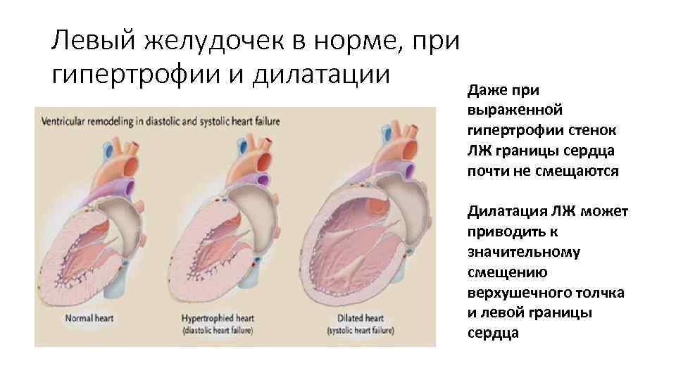 Левый желудочек в норме, при гипертрофии и дилатации Даже при выраженной гипертрофии стенок ЛЖ