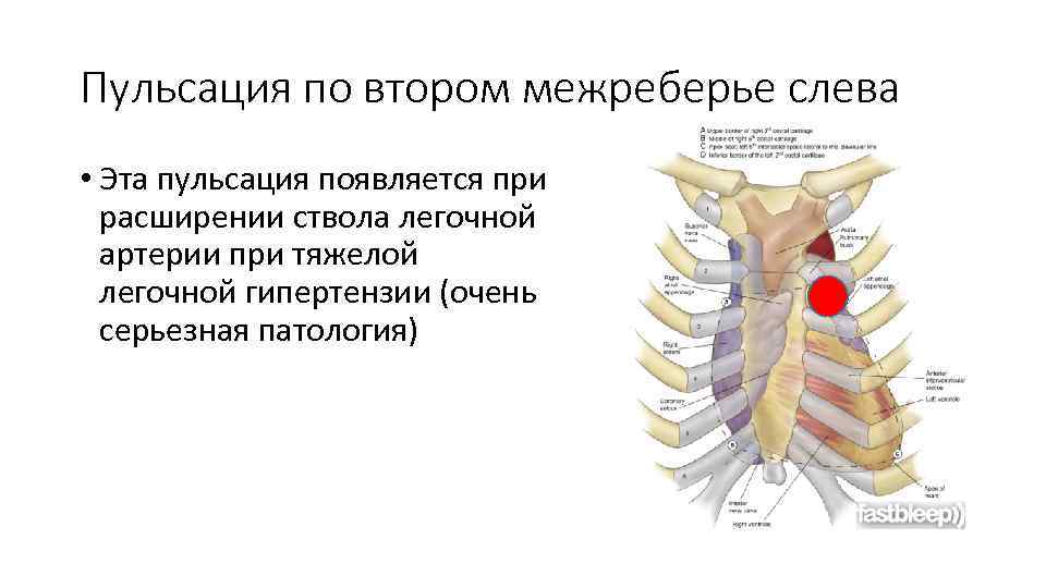 Пульсация по втором межреберье слева • Эта пульсация появляется при расширении ствола легочной артерии