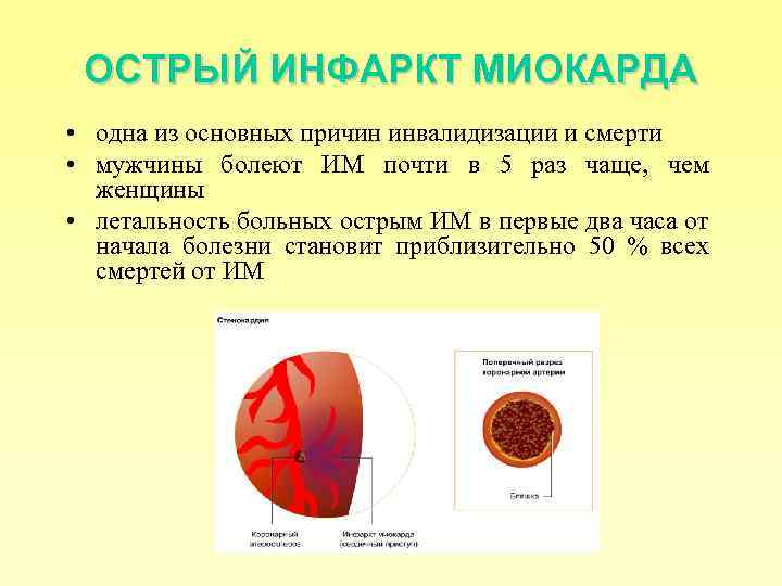 ОСТРЫЙ ИНФАРКТ МИОКАРДА • одна из основных причин инвалидизации и смерти • мужчины болеют