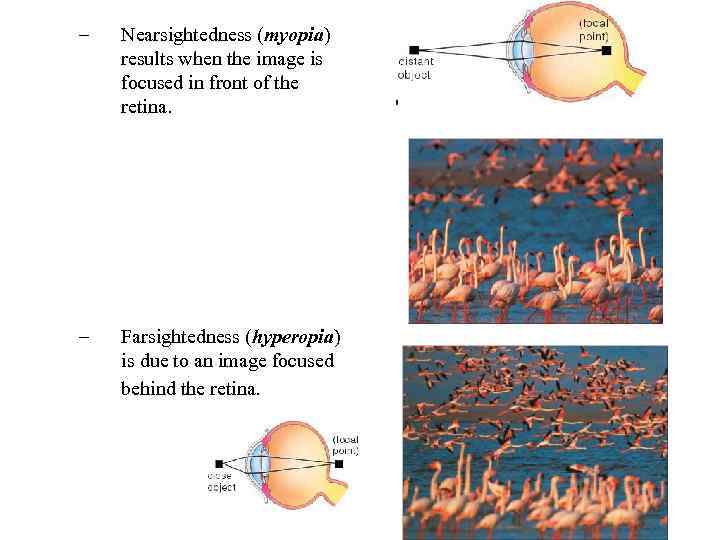 – Nearsightedness (myopia) results when the image is focused in front of the retina.