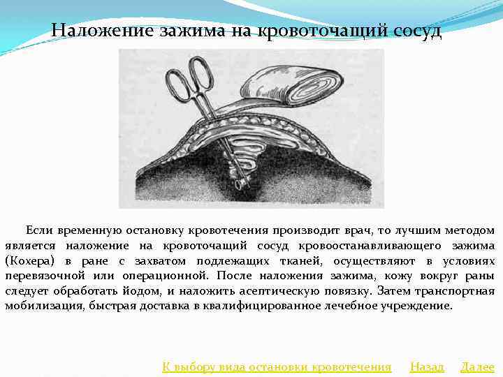 Наложение зажима на кровоточащий сосуд Если временную остановку кровотечения производит врач, то лучшим методом