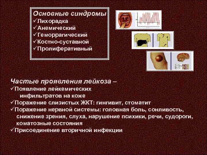 Основные синдромы üЛихорадка üАнемический üГеморрагический üКостно-суставной üПролиферативный Частые проявления лейкоза – üПоявление лейкемических инфильтратов