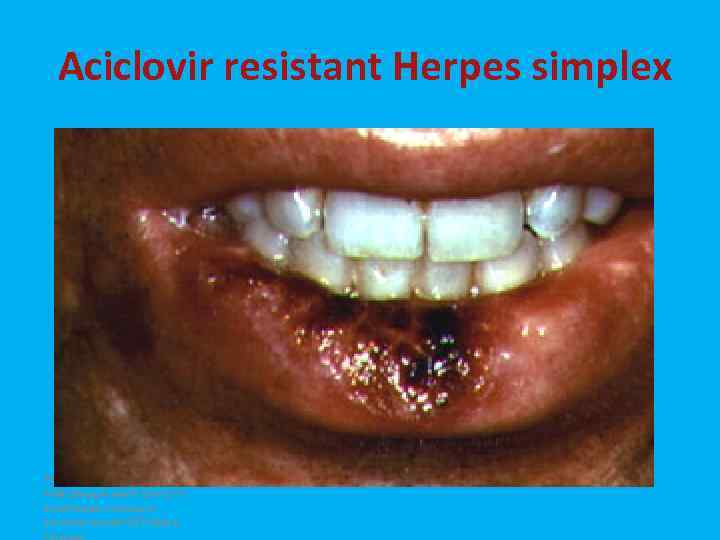 Aciclovir resistant Herpes simplex Региональный Учебно. Информационный Центр по проблемам помощи и лечения при