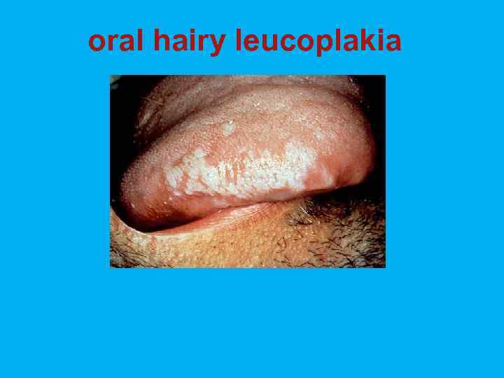 oral hairy leucoplakia 