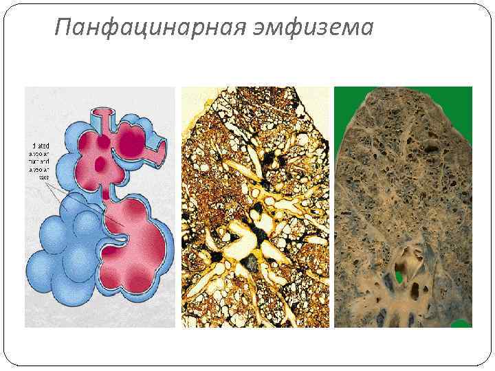 Панфацинарная эмфизема 