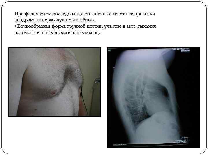 При физическом обследовании обычно выявляют все признаки синдрома гипервоздушности лёгких. • Бочкообразная форма грудной