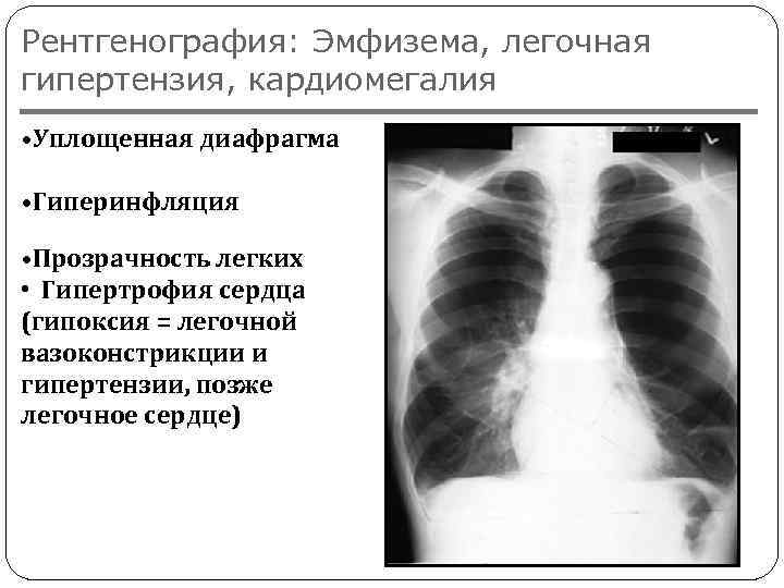 Рентгенография: Эмфизема, легочная гипертензия, кардиомегалия • Уплощенная диафрагма • Гиперинфляция • Прозрачность легких •
