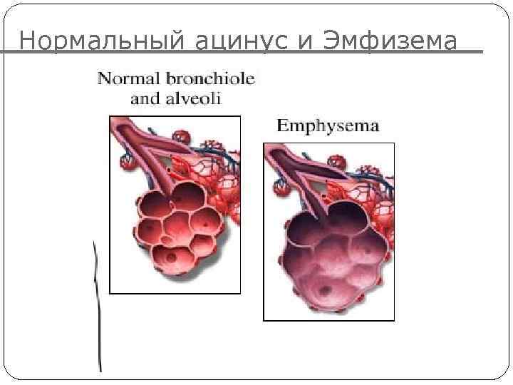 Нормальный ацинус и Эмфизема 