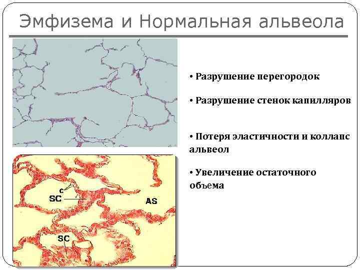 Эмфизема и Нормальная альвеола • Разрушение перегородок • Разрушение стенок капилляров • Потеря эластичности