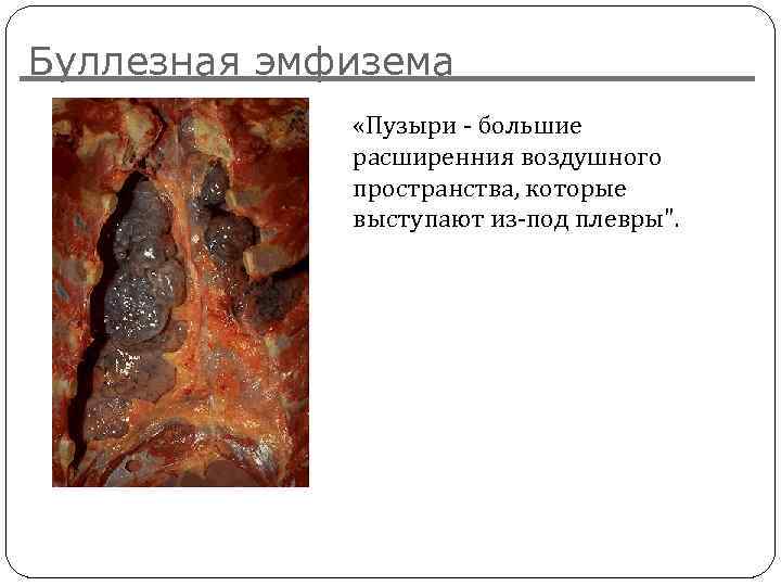 Буллезная эмфизема «Пузыри - большие расширенния воздушного пространства, которые выступают из-под плевры". [Image and